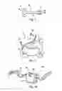 Fig. 04 - Laminoplasty fixation devices