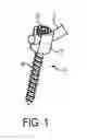 Fig. 02 - COMPRESSION-DISTRACTION SPINAL FIXATION SYSTEM
