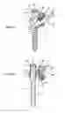 Fig. 07 - Osseous anchoring implant with a polyaxial head and method for installing the implant