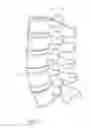 Fig. 02 - Vertebral facet joint prosthesis and method of fixation