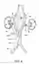 Fig. 06 - Stented vascular graft