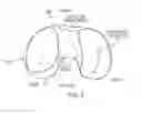 Fig. 05 - Implant for restoring normal range flexion and kinematics of the knee