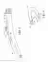 Fig. 07 - Systems and methods for positioning and compacting a bodily implant