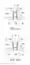 Fig. 04 - Draining device and method of draining liquid in eyelid aperture