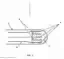 Fig. 02 - Ablation catheter electrode having multiple thermal sensors and method of use