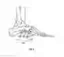 Fig. 06 - Foot, ankle and lower extremity compression and fixation system and related uses