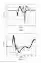 Fig. 08 - Cardiac pacing with anodal stimulation detection
