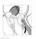 Fig. 01 - IMPLANT AND METHOD FOR IMPROVING COAPTATION OF AN ATRIOVENTRICULAR VALVE