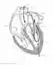Fig. 02 - IMPLANT AND METHOD FOR IMPROVING COAPTATION OF AN ATRIOVENTRICULAR VALVE