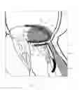 Fig. 06 - IMPLANT AND METHOD FOR IMPROVING COAPTATION OF AN ATRIOVENTRICULAR VALVE