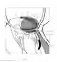 Fig. 07 - IMPLANT AND METHOD FOR IMPROVING COAPTATION OF AN ATRIOVENTRICULAR VALVE