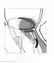 Fig. 08 - IMPLANT AND METHOD FOR IMPROVING COAPTATION OF AN ATRIOVENTRICULAR VALVE