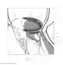 Fig. 09 - IMPLANT AND METHOD FOR IMPROVING COAPTATION OF AN ATRIOVENTRICULAR VALVE