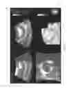 Fig. 06 - Methods and apparatuses for creating orientation markers and 3D ultrasound imaging systems using the same