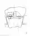 Fig. 03 - BRUSH DESIGN FOR PROPELLER DEICING SYSTEM