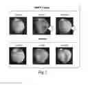 Fig. 04 - METHODS AND COMPOSITIONS FOR TREATING AND DIAGNOSING ACUTE MYOCARDIAL INFARCTION