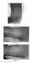 Fig. 04 - Use of pharmaceutical compositions in preparing pharmaceuticals for treating diabetic ulcer