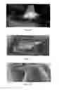 Fig. 08 - Use of pharmaceutical compositions in preparing pharmaceuticals for treating diabetic ulcer
