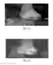 Fig. 09 - Use of pharmaceutical compositions in preparing pharmaceuticals for treating diabetic ulcer