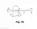 Fig. 09 - Implantable support with dilator attached to arm