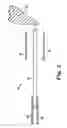 Fig. 04 - Systems, implants, tools, and methods for treatments of pelvic conditions