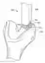 Fig. 01 - Instruments, Methods and Systems for Harvesting and Implanting Graft Materials