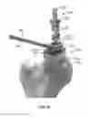 Fig. 28 - Instruments, Methods and Systems for Harvesting and Implanting Graft Materials