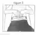 Fig. 05 - APPARATUS AND METHOD FOR DETECTING DIASTASIS RECTI