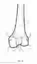 Fig. 04 - METHOD FOR KNEE RESECTION ALIGNMENT APPROXIMATION IN KNEE REPLACEMENT PROCEDURES