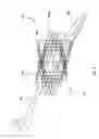 Fig. 06 - METHOD FOR KNEE RESECTION ALIGNMENT APPROXIMATION IN KNEE REPLACEMENT PROCEDURES