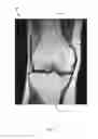 Fig. 07 - METHOD FOR KNEE RESECTION ALIGNMENT APPROXIMATION IN KNEE REPLACEMENT PROCEDURES