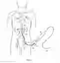 Fig. 02 - Method and apparatus for manipulating a surgical guidewire