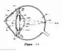 Fig. 06 - METHOD AND SYSTEM FOR ADJUSTING THE REFRACTIVE POWER OF AN IMPLANTED INTRAOCULAR LENS