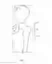 Fig. 04 - Patient-specific total hip arthroplasty