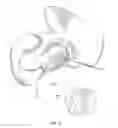 Fig. 11 - Patient-specific total hip arthroplasty