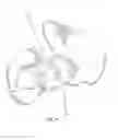 Fig. 12 - Patient-specific total hip arthroplasty