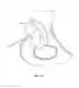Fig. 13 - Patient-specific total hip arthroplasty
