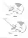 Fig. 17 - Patient-specific total hip arthroplasty