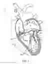 Fig. 02 - Gripper pusher mechanism for tissue apposition systems
