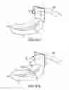 Fig. 55 - Gripper pusher mechanism for tissue apposition systems