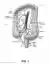 Fig. 02 - Anastomosis probe and cutting device