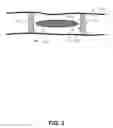 Fig. 03 - Anastomosis probe and cutting device