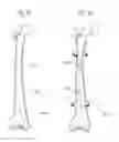 Fig. 07 - METHODS AND APPARATUS FOR BONE RESHAPING