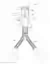 Fig. 01 - Variable depression stents (VDS) and billowing graft assemblies