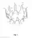 Fig. 02 - Variable depression stents (VDS) and billowing graft assemblies