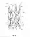 Fig. 05 - Variable depression stents (VDS) and billowing graft assemblies