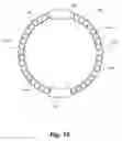 Fig. 18 - Variable depression stents (VDS) and billowing graft assemblies