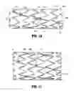 Fig. 08 - Vascular Stent