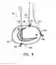 Fig. 09 - Adjustable annuloplasty devices and adjustment mechanisms therefor
