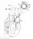 Fig. 28 - Adjustable annuloplasty devices and adjustment mechanisms therefor